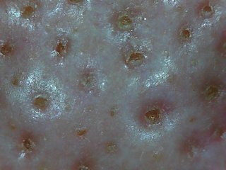 角栓をピンセットで抜くのがやめられない！埼玉県越谷市 毛穴ケア専門サロン ザエバーグリーン