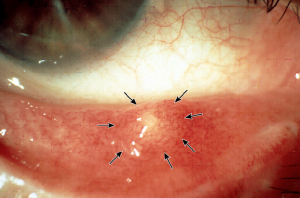 ものもらい 麦粒腫 の写真・画像素材-Snapmart スナップマート