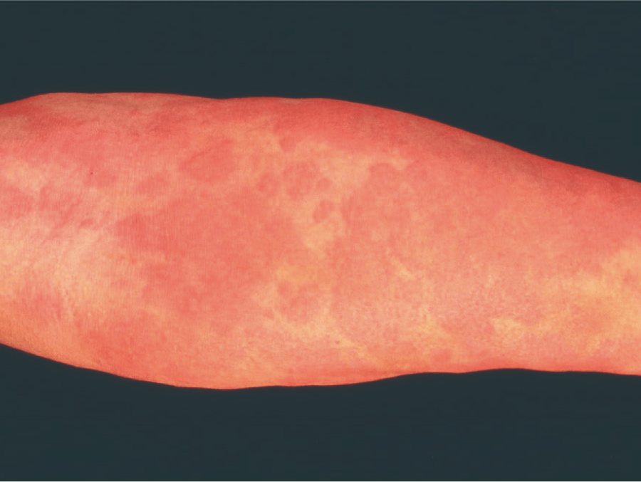 あせも 汗疹 』の原因・症状・治療法 症例画像 田辺三菱製薬ヒフノコトサイト