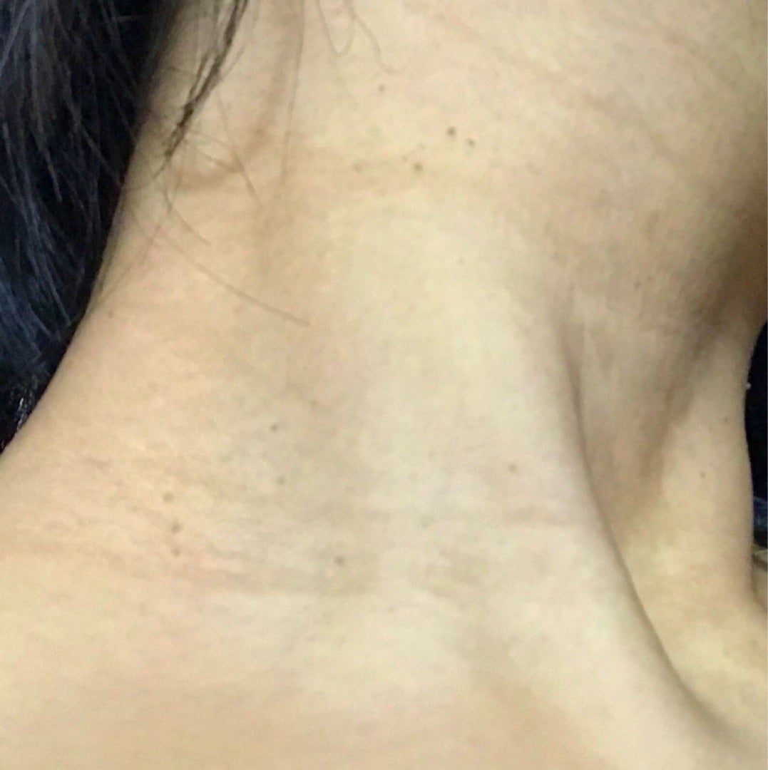 首イボ アクロコルドン、スキンタッグ公式 富士見スキンクリニック飯田橋千代田区の皮膚科