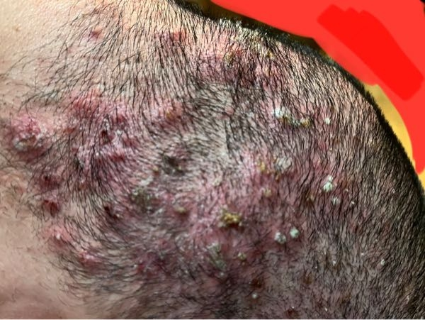 毛髪診断士監修 頭皮ニキビの原因や治し方は？かゆいときの対処法や間違えやすい病気も解説スカルプD コラムスカルプD公式サイトアンファ