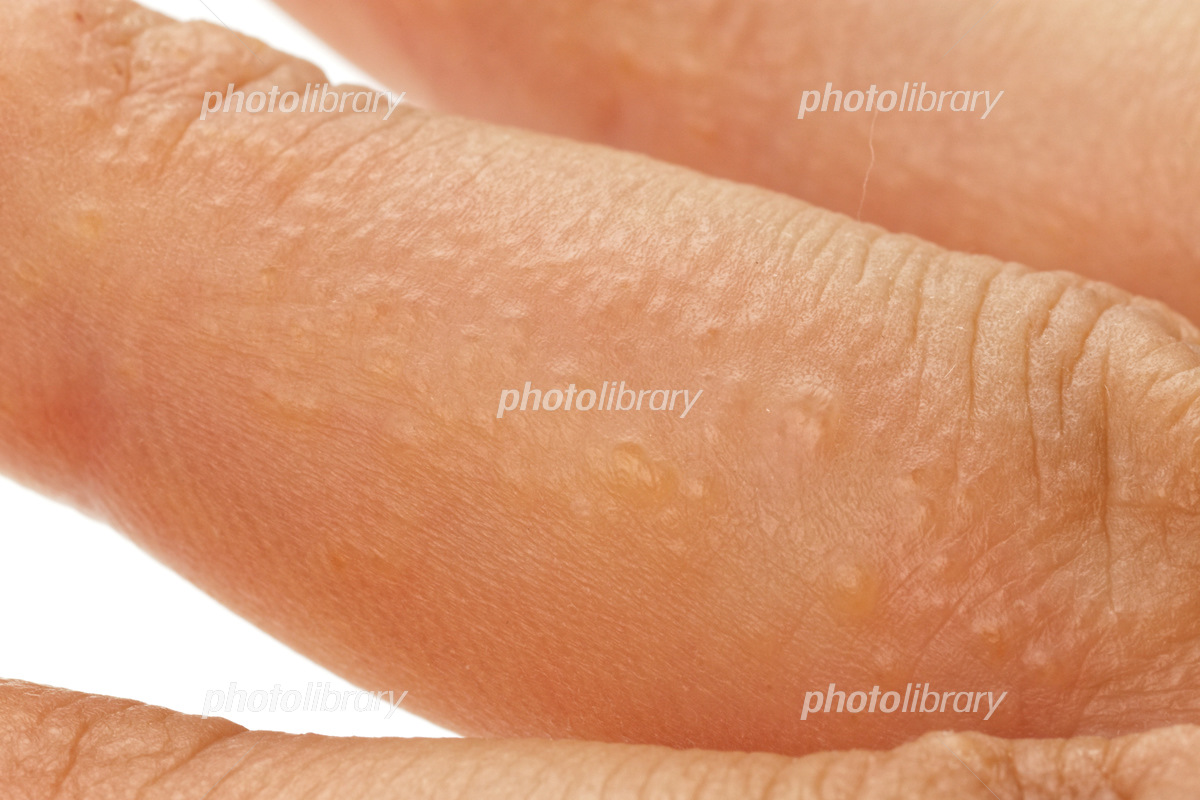 手湿疹・水前寺皮フ科医院熊本市の皮膚科・形成外科・アレルギー科