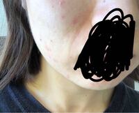 メンズのニキビ治療 男性専門ゴリラクリニック