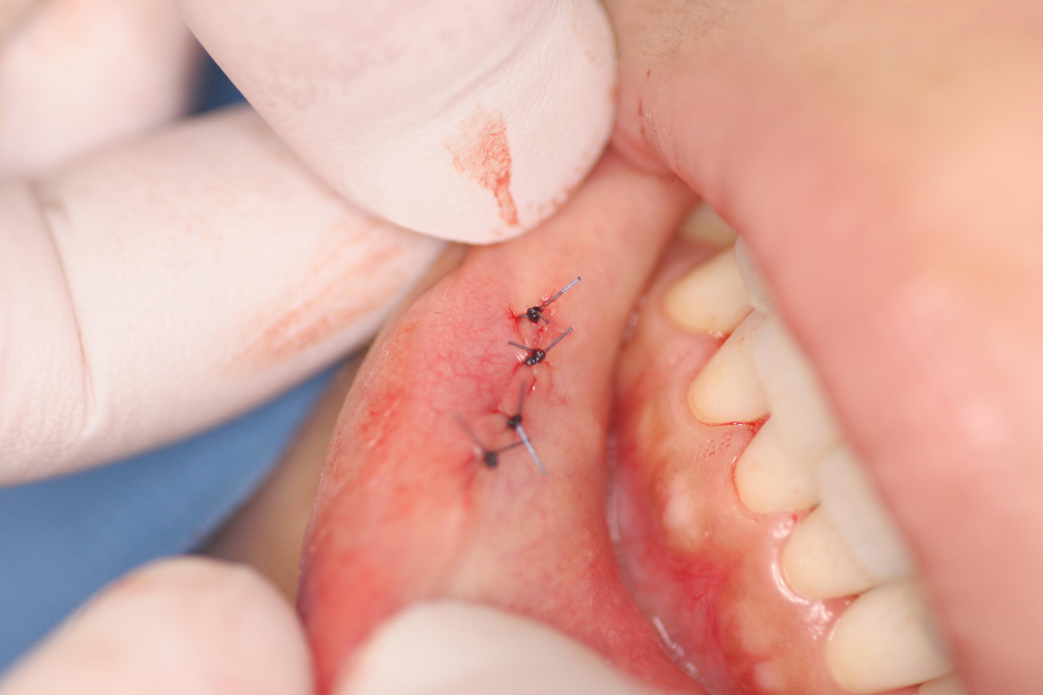 軟性線維腫 アクロコルドン を除去 - 東京・大阪の美容皮膚科ならFLALU フラルクリニック