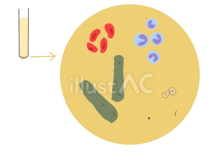 尿検査の準備をする女の子のフリーイラストフリーイラスト・クラシック フリクラ