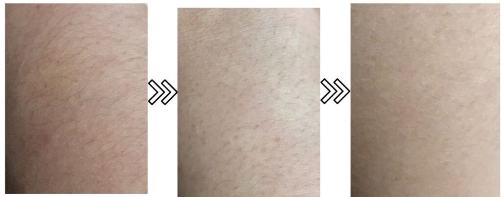 ミュゼ除毛クリームはVIOに使える？実際に試して口コミ効果を検証！ PRFirst Time