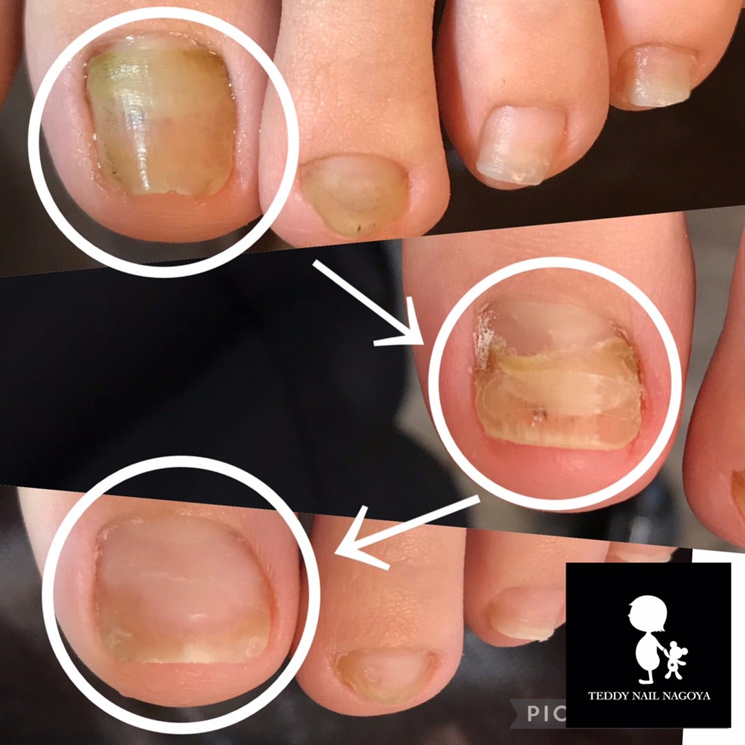 足の爪の悩み -公式 育爪素のままで美しい爪へ
