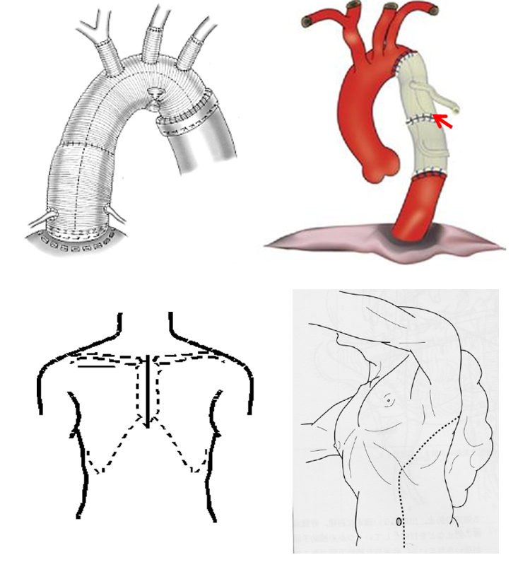 胸部大動脈瘤とはどんな病気？ ～約60％が破裂するまで無症状で進行する～メディカルノート
