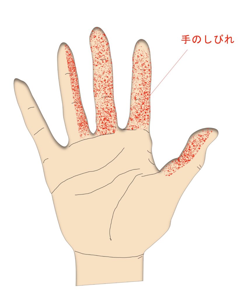 手根管症候群について - 大阪 ばね指の手術・治療 医療法人 古東整形外科