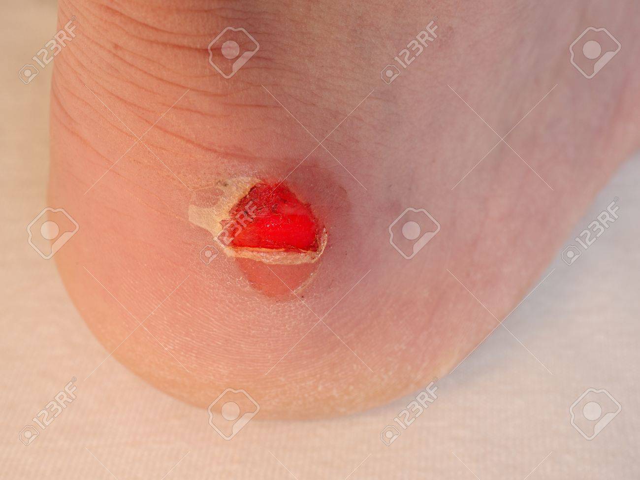 水ぶくれは潰していい？早く治すために正しい対処法を医師が解説 やけど 虫刺され 靴擦れ- オンライン診療ならウチカラクリニック