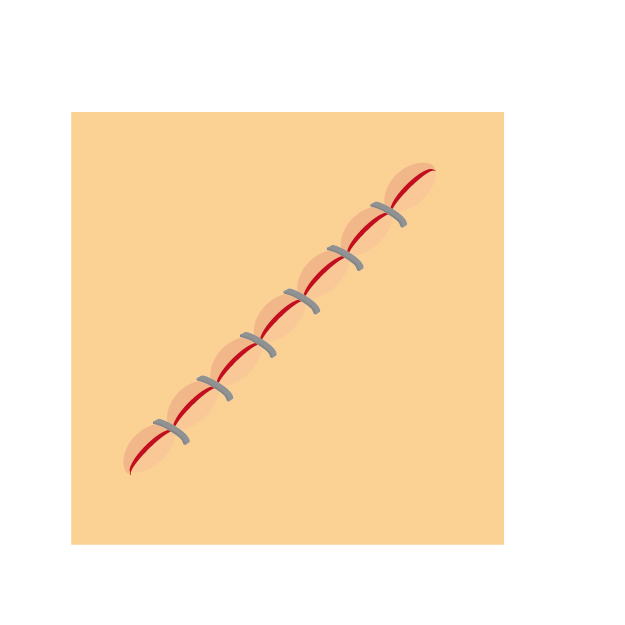 手術時の真皮縫合について：抜糸が不要で傷跡が目立ちにくい縫合方法とは？ 西宮敬愛会病院COKU鼠径ヘルニアセンター- 西宮敬愛会病院 COKU鼠径ヘルニア・内視鏡センタ