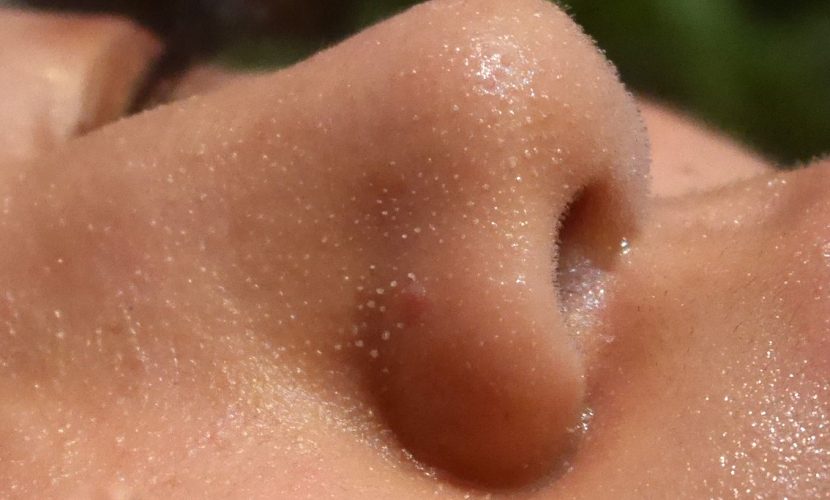 鼻の下の赤みとニキビ、ぶつぶつを治す方法はありますか？ - 鼻の下- Yahoo!知恵袋