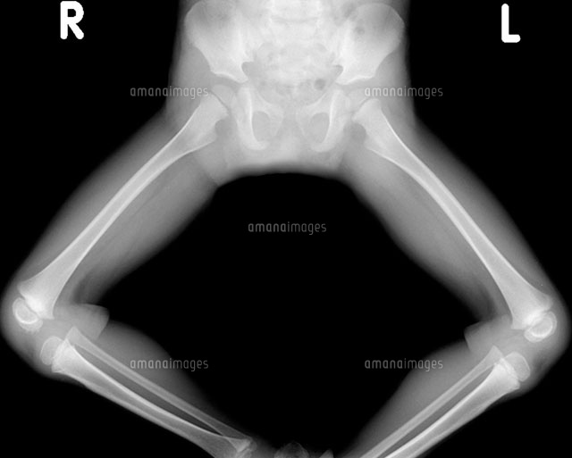 男性の骨盤のレントゲン写真の写真素材・画像素材 Image 46939177