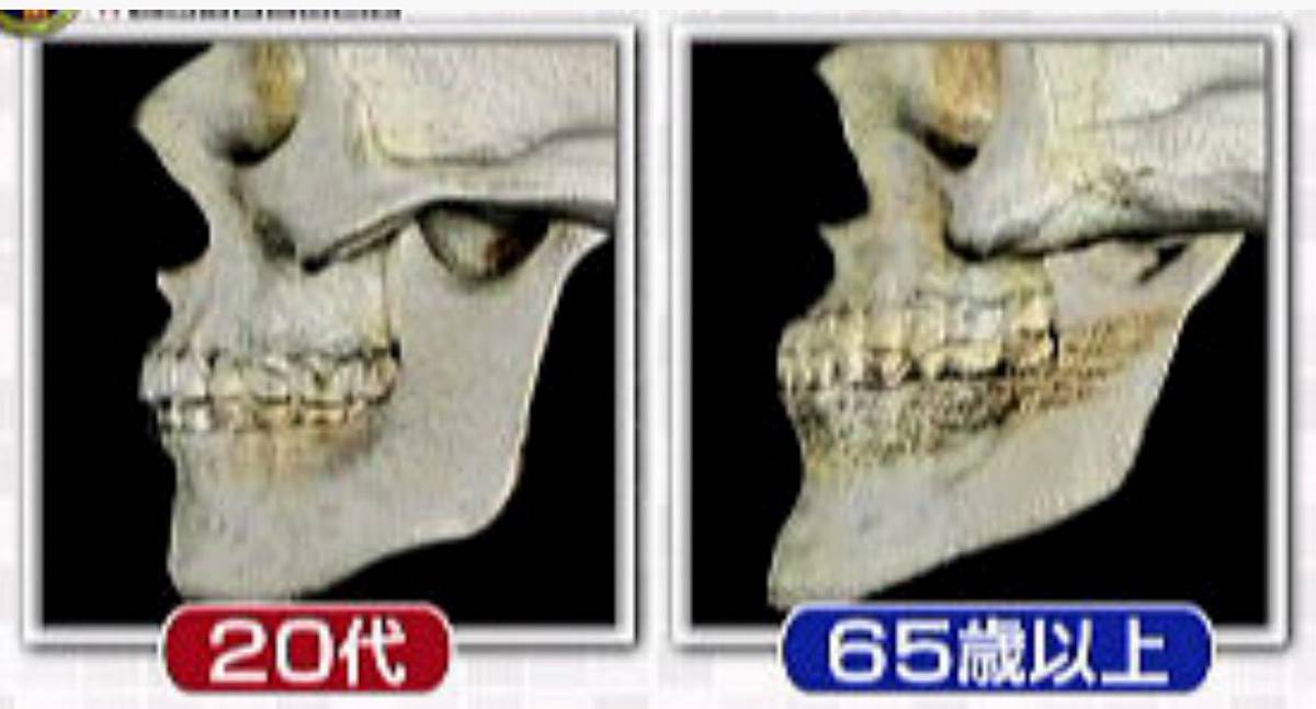 うなじの位置で、顔の骨格老化がわかる？！ うなじの位置を気にした事ありますか？ 年々、うなじがなんだか垂れ下がってきて、頭の形も絶壁で、ポニーテールや外人さんがよくするくしゃくしゃのかわいいお団子ヘアが全く似合わない！疲れた主婦感、落ち武者感、平安時代