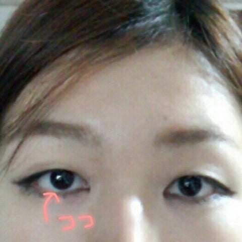 くまとり後の三白眼を修正 下眼瞼拡大修正 手術後3か月、1週間高野医師ブログ表参道・青山の美容整形「KAUNIS CLINICカウニスクリニック」