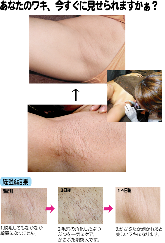 脇の毛穴のブツブツはなくせる？原因や処理方法のおすすめなどを徹底解説します│メンズジェニ