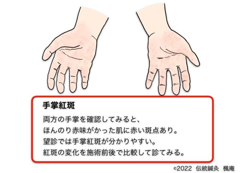手掌紅斑 しゅしょうこうはん って知ってる🤔❓ ⁡ ✍🏻 肝臓の機能が低下すると手のひらや指先が赤くなること。 