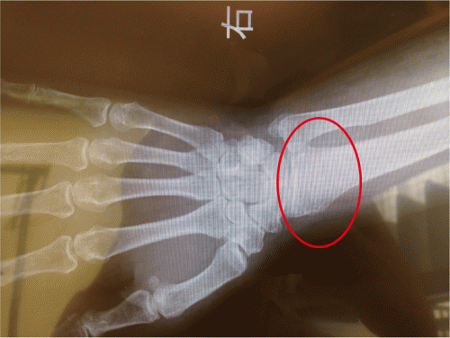 骨端線とは？手のレントゲン画像から身長を予測！医療法人社団 東整会 東京神田整形外科クリニック