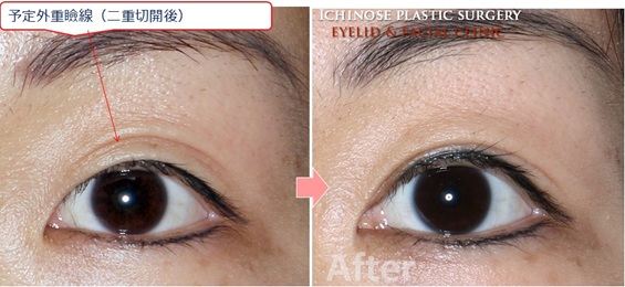 三重まぶたを放置すると癖が定着して悪化する