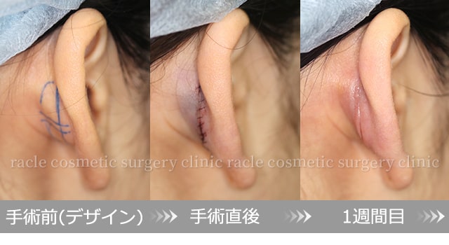 耳介軟骨移植鼻尖新宿ラクル美容外科クリニック