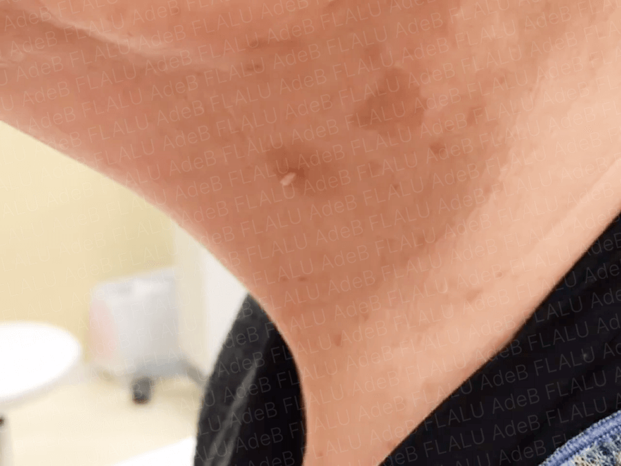 デルマトロン -シミ・首のイボ スキンタッグ の治療板橋区の西台高島平内科・内視鏡・皮膚科クリニック