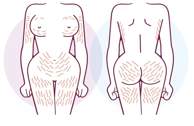 ふくらはぎに肉割れが起こる4つの原因と対策・ケア方法を紹介！ - グラマラスパッツシリーズ公式サイトYB-LAB
