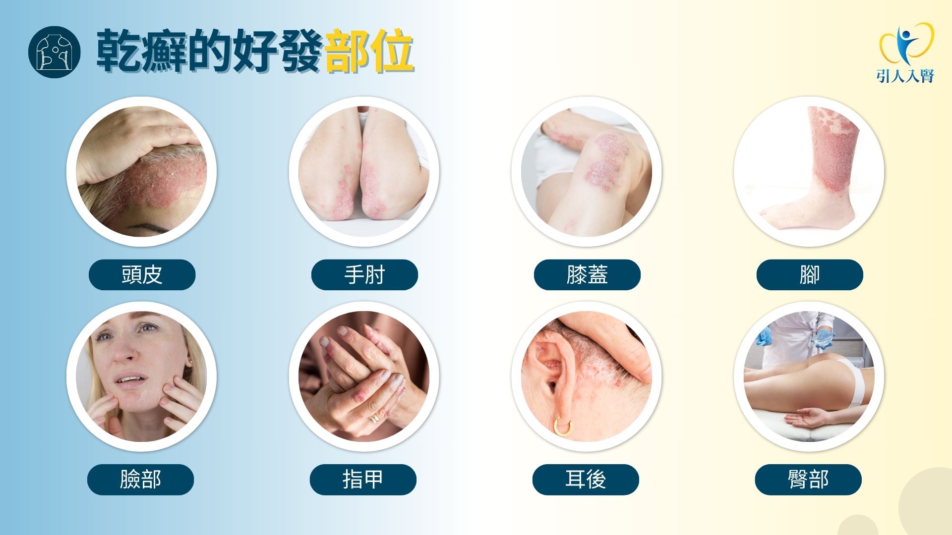 你的頭皮問題醫師來解答 傷口會讓乾癬復發？皮膚科蔡雅竹醫師為你解答