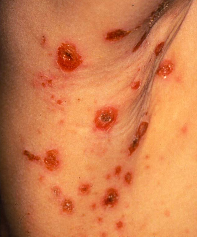 排膿路 フィステル とは？歯茎の白い出来物の治療方法とは？ 東京日本橋の歯科医院 北川デンタルオフィス