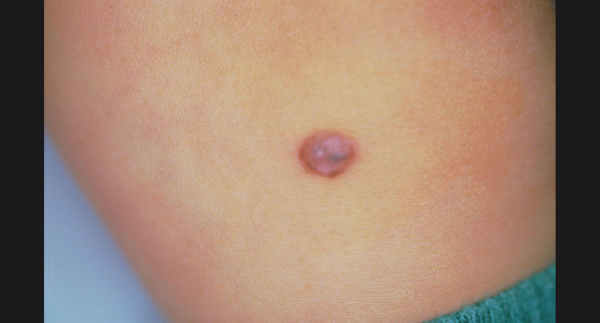 皮膚T細胞リンパ腫の種類と治療について-渋谷駅前おおしま皮膚科