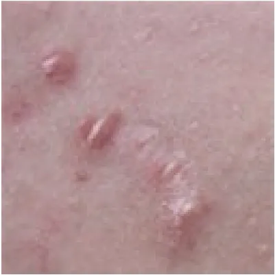 マラセチア毛包炎杉沢皮膚科クリニック