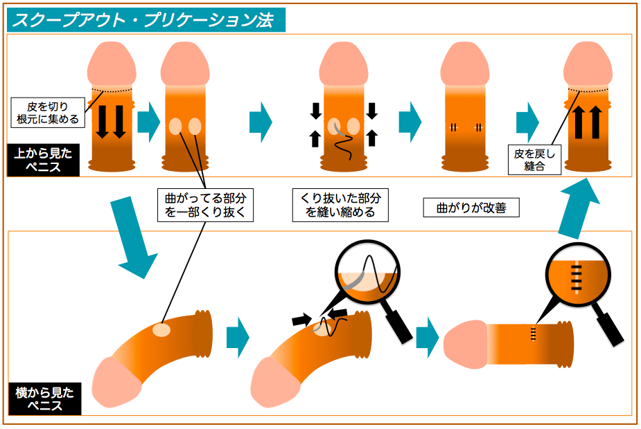 包茎（ほうけい）について知ろう！【医師監修】 | セイシル