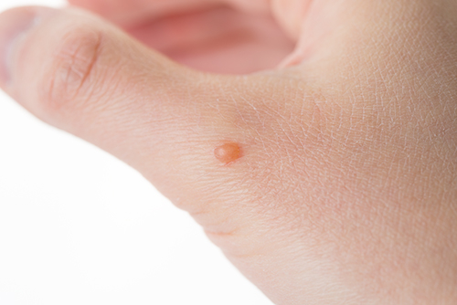 水いぼ 伝染性軟属腫 吹田市の皮膚科もりはら皮ふ科クリニック