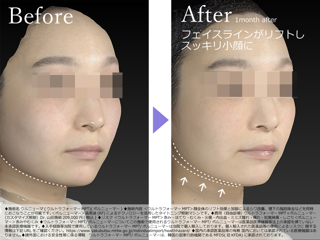 レモンボトルで顔バランスの調整「ビフォーアフター」ブログ