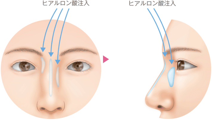 斜鼻形成銀座マイアミ美容外科