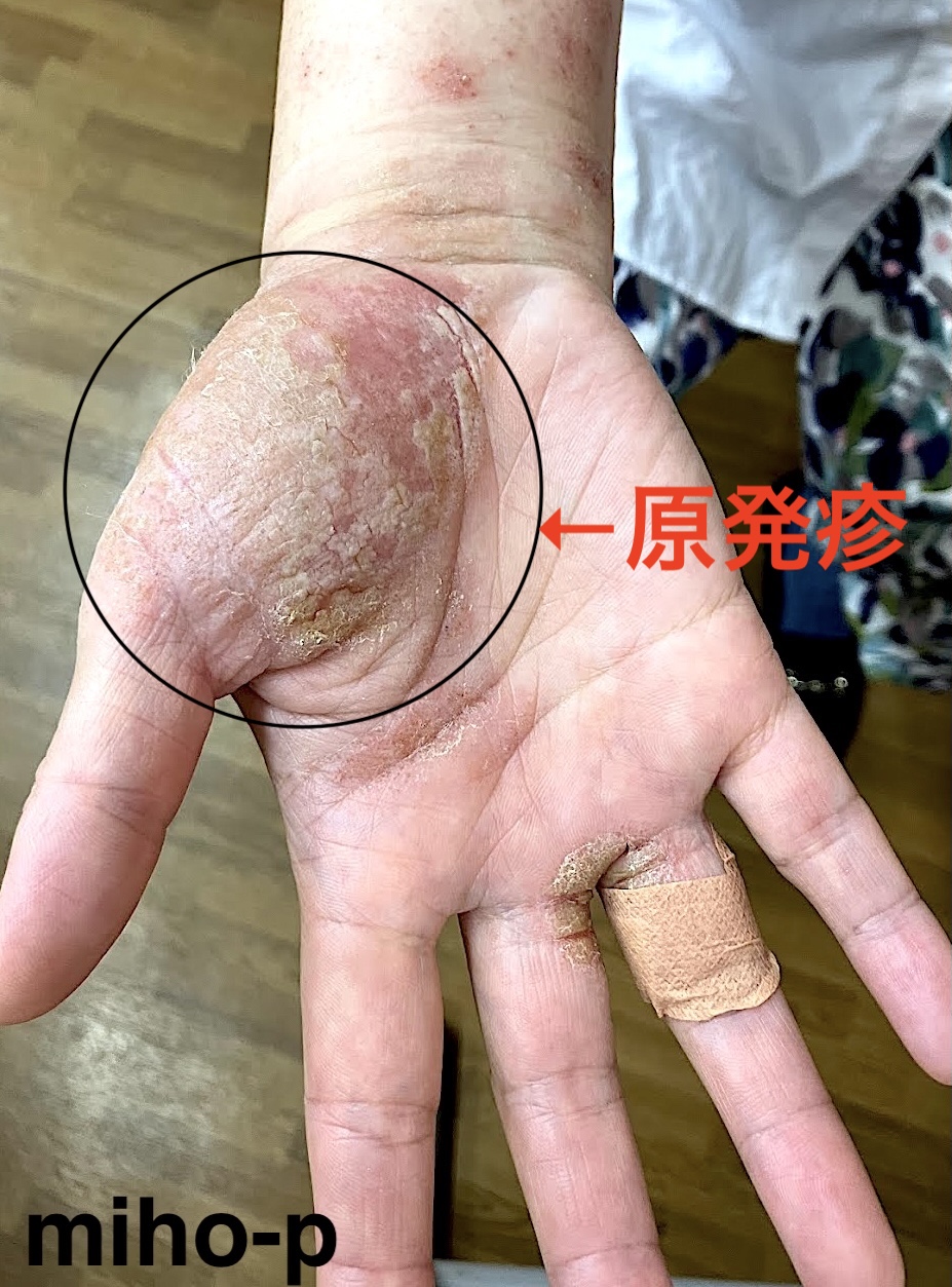 皮膚がん画像 - 皮膚がん財団のAIM