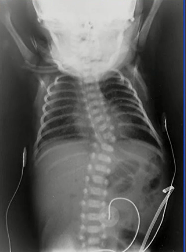 脊柱後縦靭帯骨化症の発症原因の一端を解明理化学研究所