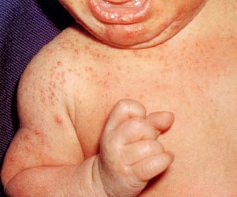 汗による肌トラブル あせも、汗のかぶれ原因・症状・治療法肌トラブル情報館池田模範堂