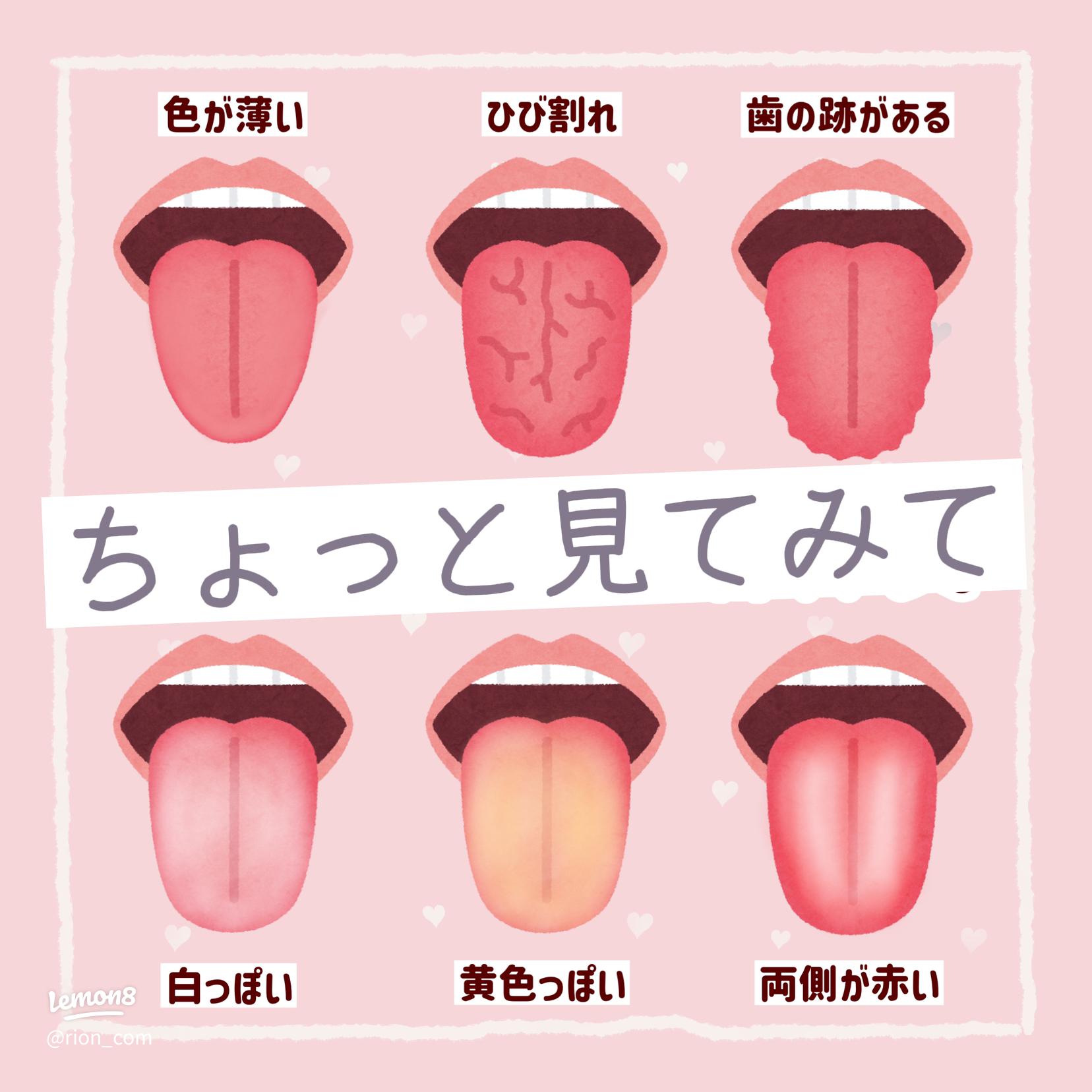 溝状舌についてスタッフブログ