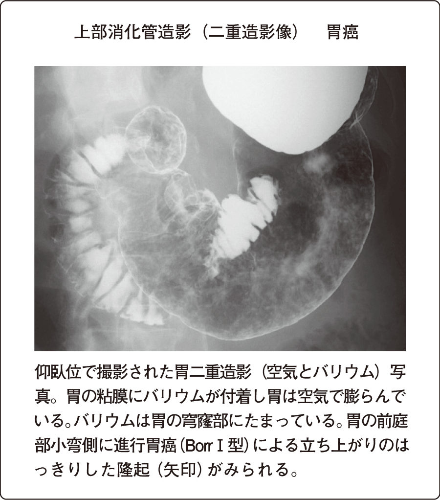 ヘリコバクター・ピロリの感染診断の決め手は 「温かいバリウム？」～胃Ｘ線検査の見地より – Radiology@Home