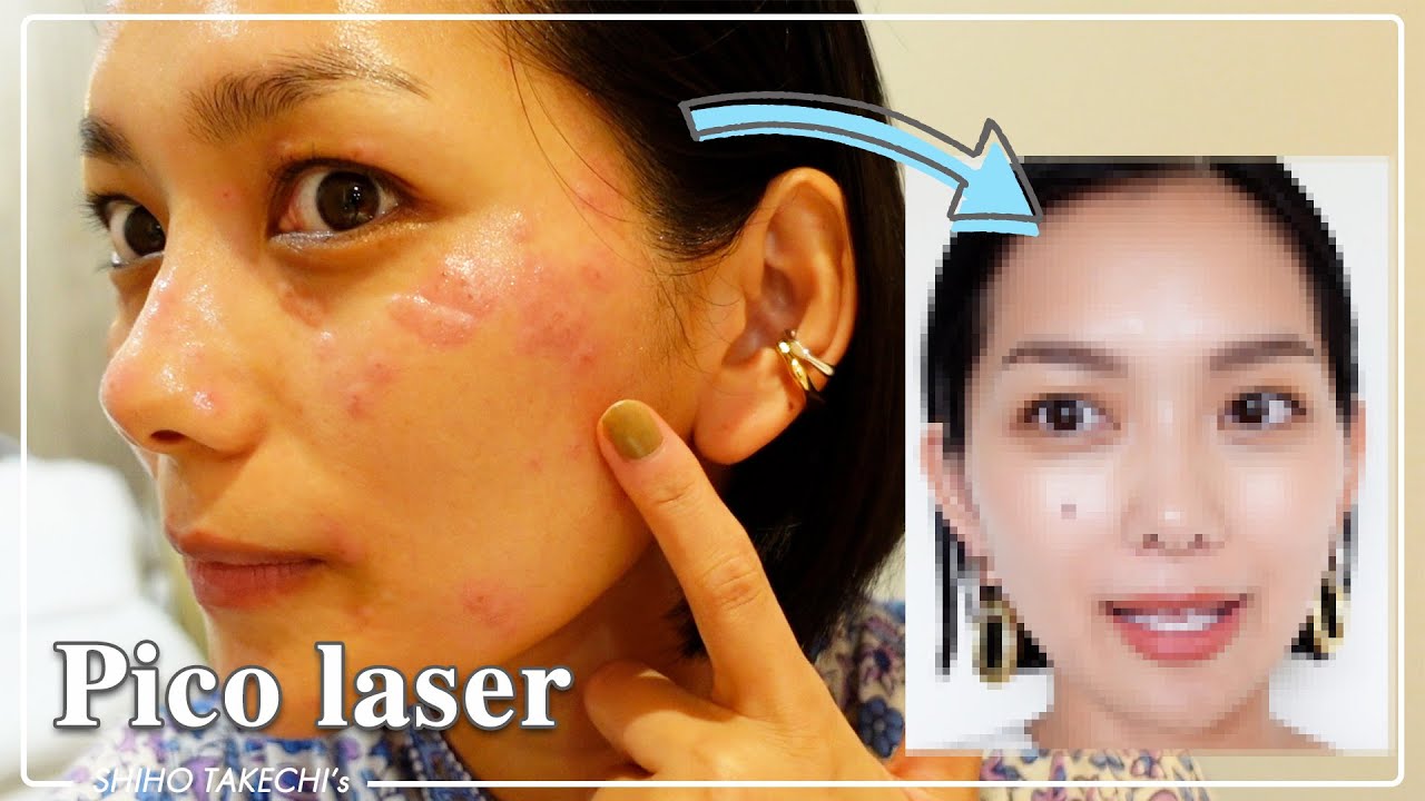 シミ取りレーザー治療ヴィヴェンシアクリニック