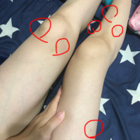 黄あざができる原因は？腕や胸・太ももに身に覚えのないできるあざの対処方法や病気の可能性を解説