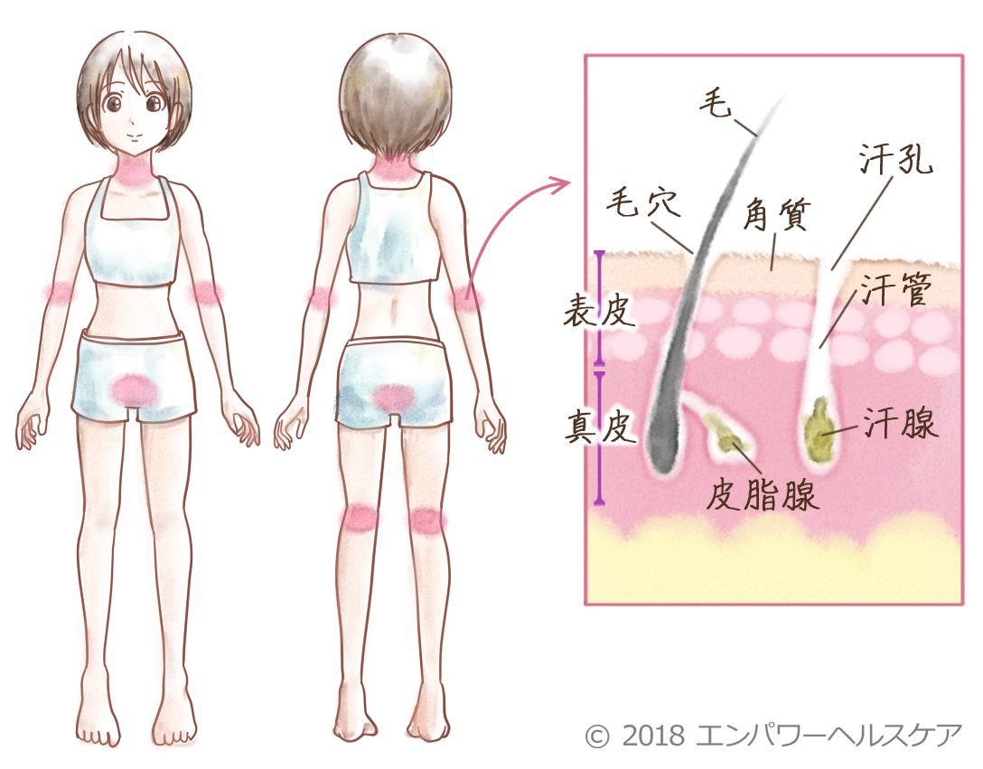 背中・顔・首から浸出液の出ていたアトピー.1大阪・茨木市 重度のアトピー専門鍼灸 悠々堂まき鍼灸院