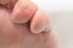 指の〇〇が消えてゆく・ - よゆうのある暮らし