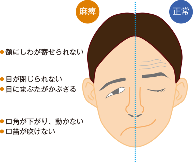脳卒中ジョンソン・エンド・ジョンソン メディカル カンパニ