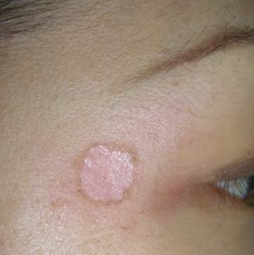 シミ取りレーザーの経過とアフターケアを解説！色素沈着やかさぶたが落ち着くのはいつ？品川美容外科 公式