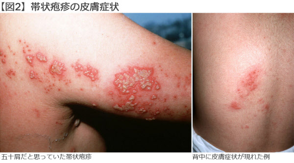 帯状疱疹ひふのクリニック人形町