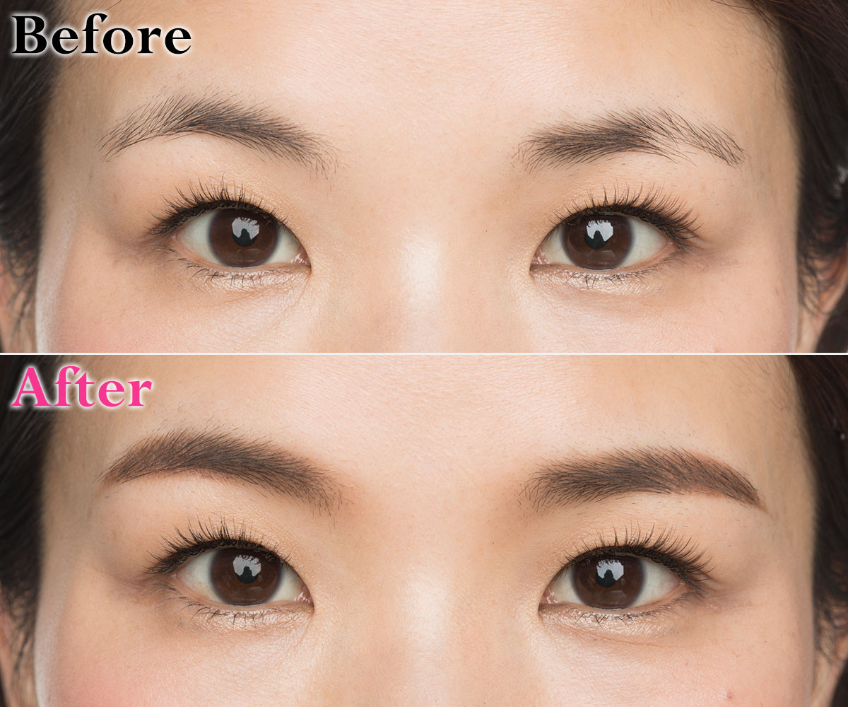 眼瞼下垂-017、眉間-003、プロ-004-2美容整形・美容外科のヴェリテクリニック 公式東京・名古屋・大阪