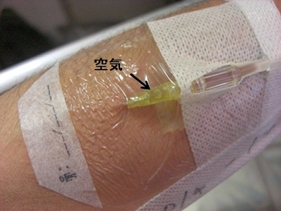 点滴ルートに空気混入で塞栓症に！？どのくらい入ると危険？エア抜き方法は？看護 - コワニブログ