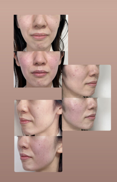 ビフォーアフター有インモードとは？プロが効果やメリットを解説│SELECT CLINIC TIPS