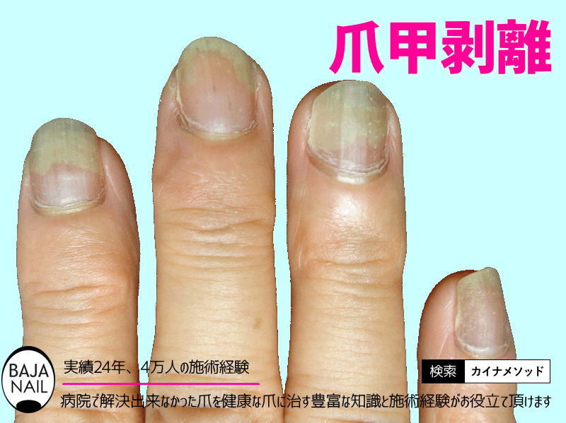 爪」表面に縦線、横線 ひょっとして病気のサイン？ 気になる疑問を医師に聞くオトナンサ